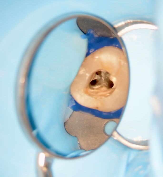 Temporäre Einlagen in der Endodontie | SpringerLink