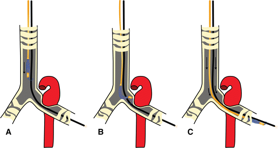 Cinching the loop on the Arndt endobronchial blocker during placement for  descending aortic aneurysm surgery | SpringerLink