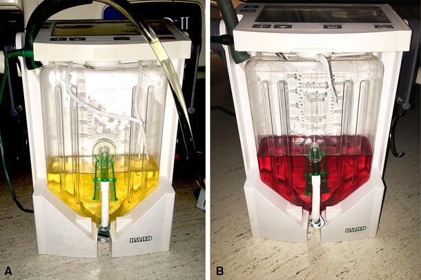 does b12 injections cause red urine Red urinary discolouration following hydroxocobalamin treatment for  vasoplegic syndrome | Canadian Journal of Anesthesia/Journal canadien  d'anesthésie