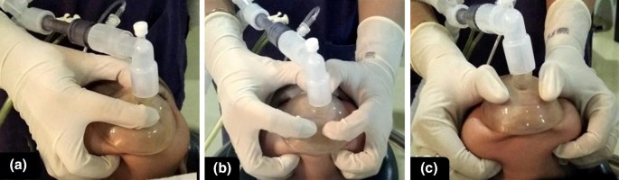 Comparison of three techniques of face mask ventilation in children less  than two years of age—a randomized crossover study | SpringerLink