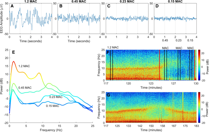 An Updated Introduction To Electroencephalogram Based Brain Monitoring During Intended General Anesthesia Springerlink