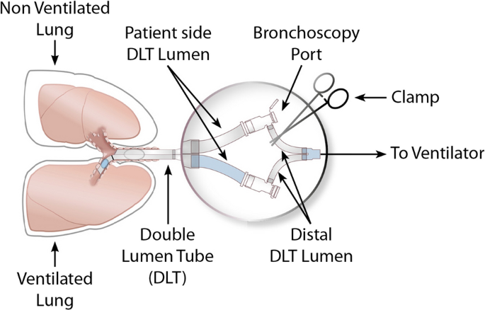 Non-ventilated lung deflation during one-lung ventilation with a  double-lumen endotracheal tube: a randomized-controlled trial of occluding  the non-ventilated endobronchial lumen before pleural opening | SpringerLink
