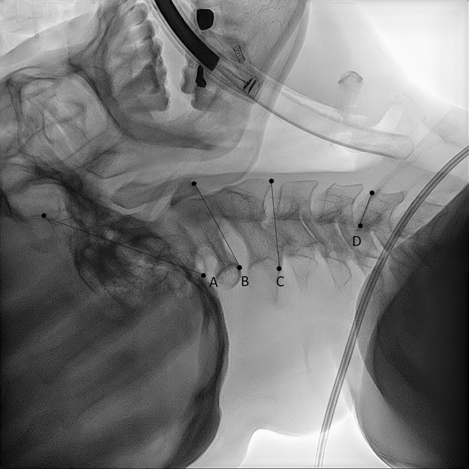 Effects of the head-elevated position on cervical spine motion during ...