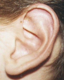 Ohren anlegen fadenmethode erfahrungen
