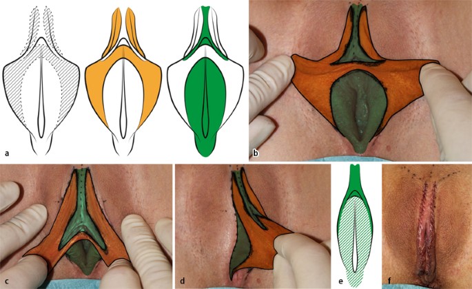 Bilder schamlippe verkleinern Compress JPEG