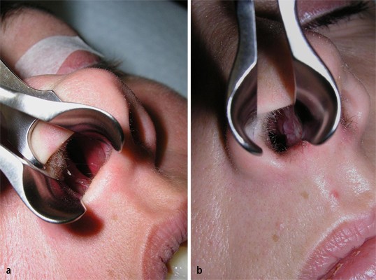 Verkrustungen in der nase nach op