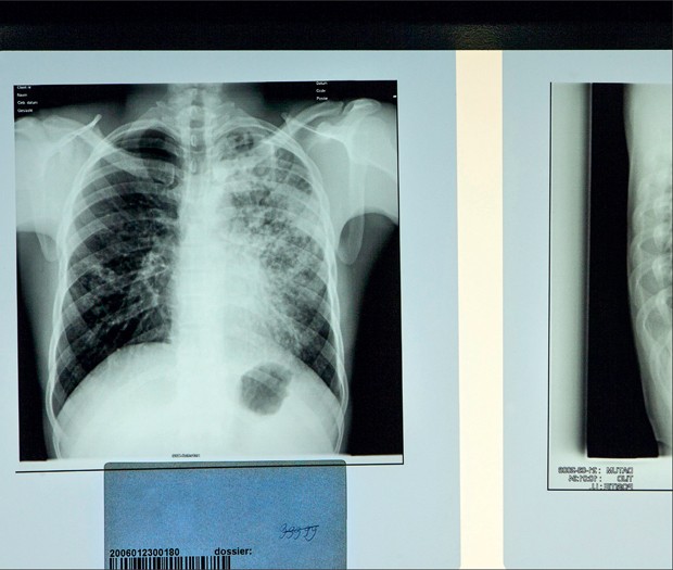 Aerogene Bacteriele Infecties Springerlink