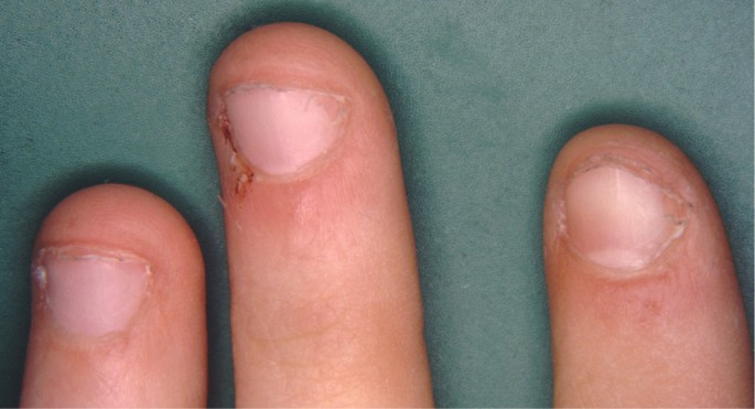 Finger im Focus: Kosmetologische Veränderungen der Nägel | SpringerLink
