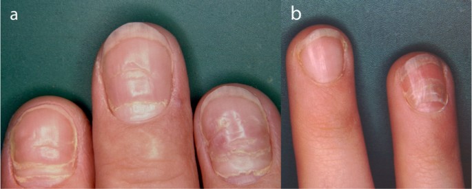 Finger im Focus: Kosmetologische Veränderungen der Nägel | SpringerLink