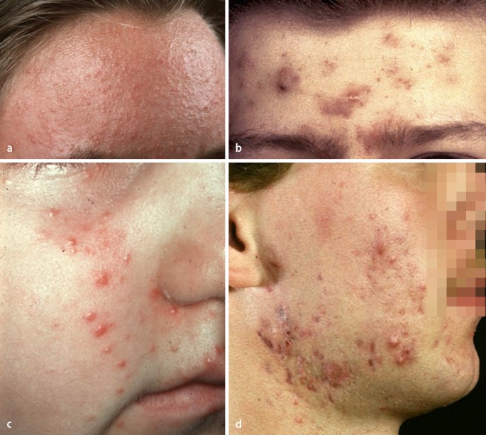 Acne Vulgaris Springerlink