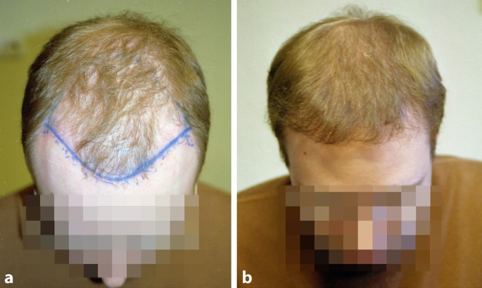 Haartransplantation beim Mann | SpringerLink