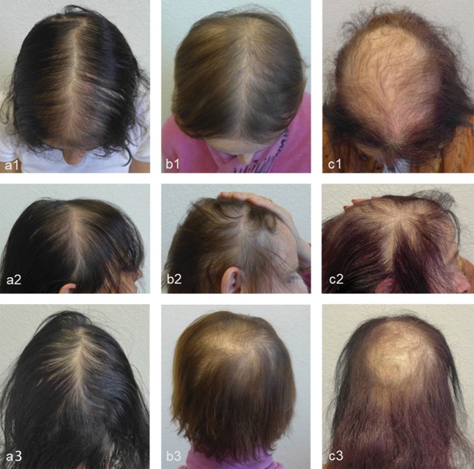 Alopecia androgenetica der Frau | SpringerLink