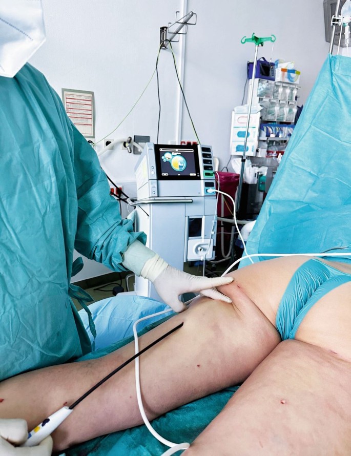 vibrations assistierte liposuktion Fettabsaugung Frankfurt ▷ Sanfte Konturen