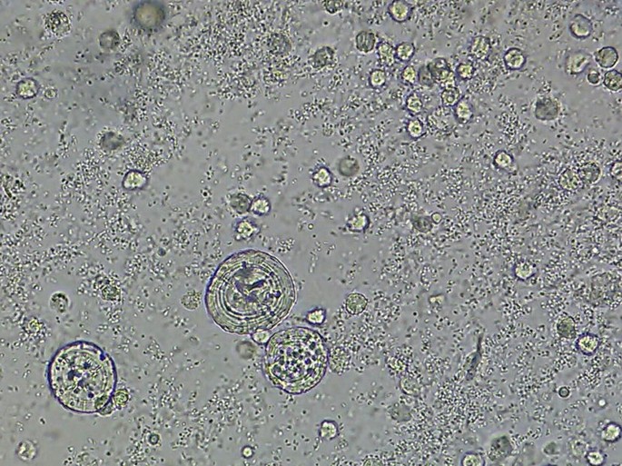 enterobius vermicularis urine