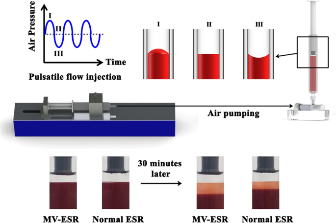 Micro-vibrational erythrocyte sedimentation rate (ESR) for sensitive  measurement of erythrocyte aggregation | SpringerLink