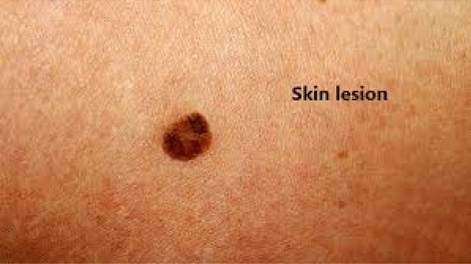 skin lesion classification using decision trees and random forest algorithms springerlink