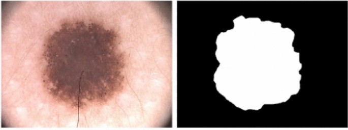skin lesion classification using decision trees and random forest algorithms springerlink