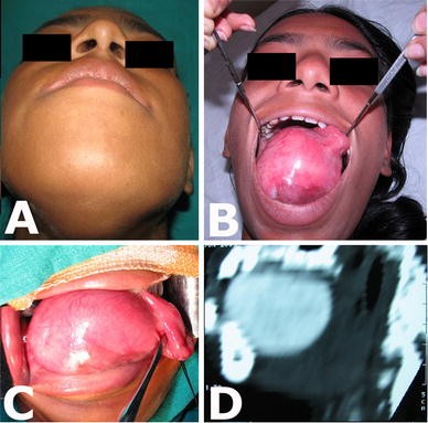 Giant Sublingual Dermoid Cyst In Floor Of The Mouth Springerlink