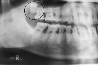 Impacted Inverted Teeth with their Possible Treatment Protocols |  SpringerLink