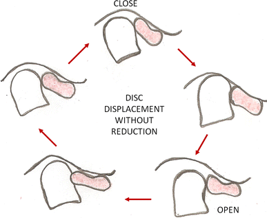 Temporomandibular Joint Arthrocentesis for Internal Derangement with Disc  Displacement Without Reduction | Journal of Maxillofacial and Oral Surgery