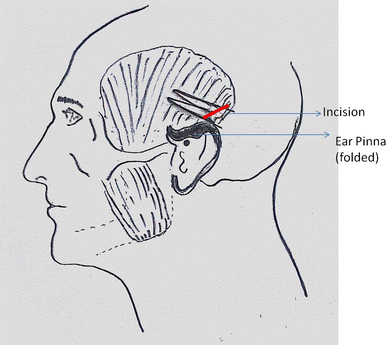 Posterior Auricular Approach For Decompression And Drainage Of