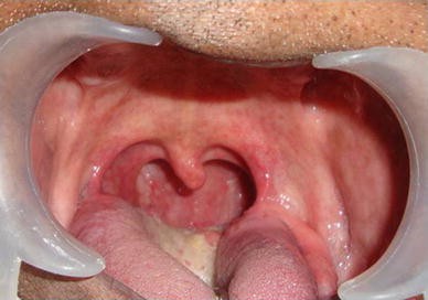High Palatoglossal Arch: A New Indication for Pre-prosthetic Surgery |  SpringerLink