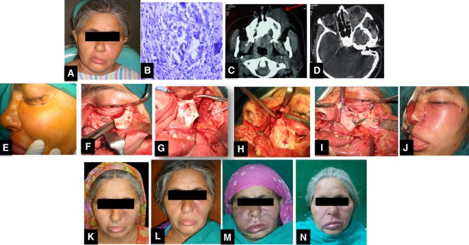 Fungal Rhinosinusitis Unravelling The Disease Spectrum Springerlink Fungal Rhinosinusitis Unravelling The Disease Spectrum Springerlink