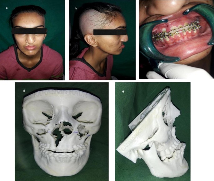 3d Models Revolutionizing Surgical Outcomes In Oral And Maxillofacial Surgery Experience At Our Center Springerlink