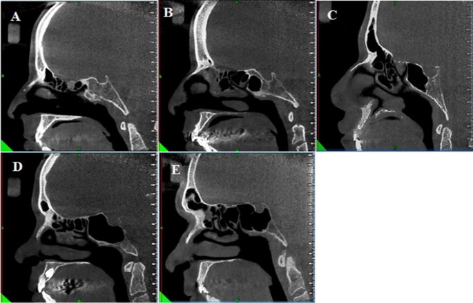 Cone Beam Computed Tomography Analysis of Sphenoid Sinus Pneumatization and  Relationship with Neurovascular Structures | SpringerLink