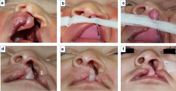 No Nose Or Lips Facial Deformities No Nose Or Lips Facial Deformities