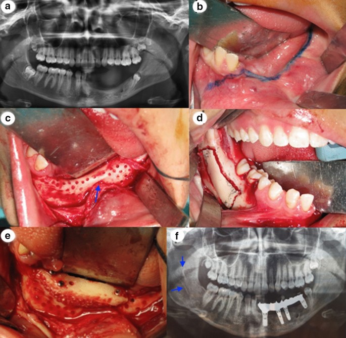 melanotic neuroectodermal tumor of infancy treatment Mandibular Melanotic Neuroectodermal Tumor of Infancy: Interdisciplinary Treatment from 2 Months to 19 Years of Age | Journal of Maxillofacial and Oral Surgery