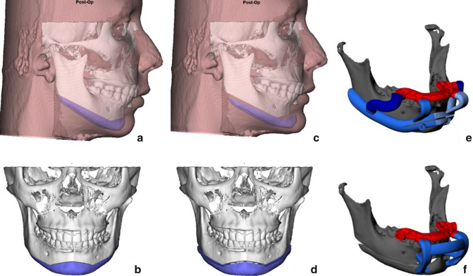 Chin Wing Osteotomy for Improving Mandible Projection and Contour in  Patients with Normal Occlusion: Case Reports | Journal of Maxillofacial and  Oral Surgery