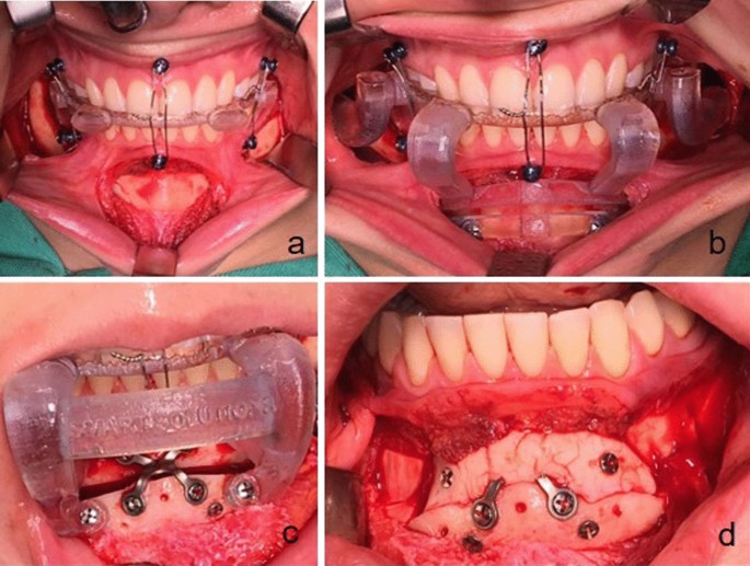 Chin Wing Osteotomy for Improving Mandible Projection and Contour in  Patients with Normal Occlusion: Case Reports | Journal of Maxillofacial and  Oral Surgery