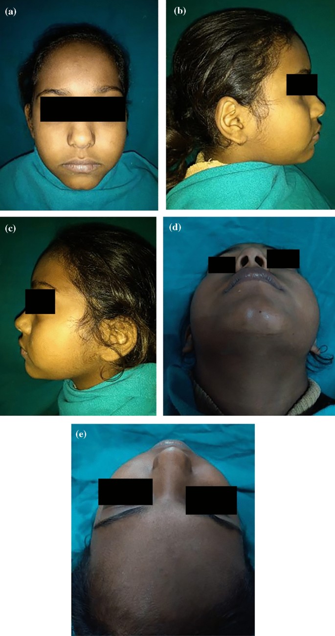 A prospective study of the role of intralesional bleomycin in orbital  lymphangioma, image size:685x1300