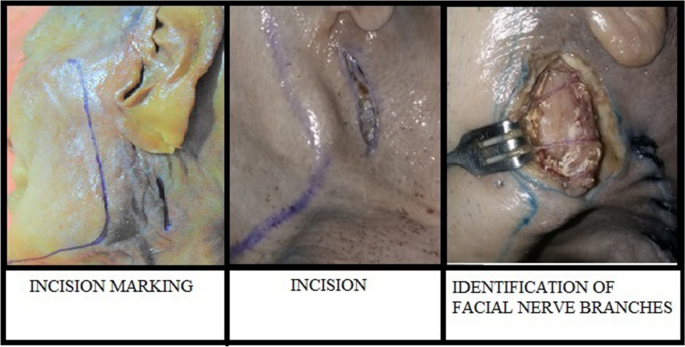 Preserving the marginal mandibular branch of the facial nerve during  submandibular region surgery: a cadaveric safety study, Patient Safety in  Surgery