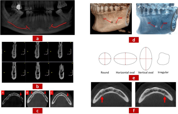 A Cross-Sectional CBCT Study of Anterior Loop, Accessory Mental Foramen ...