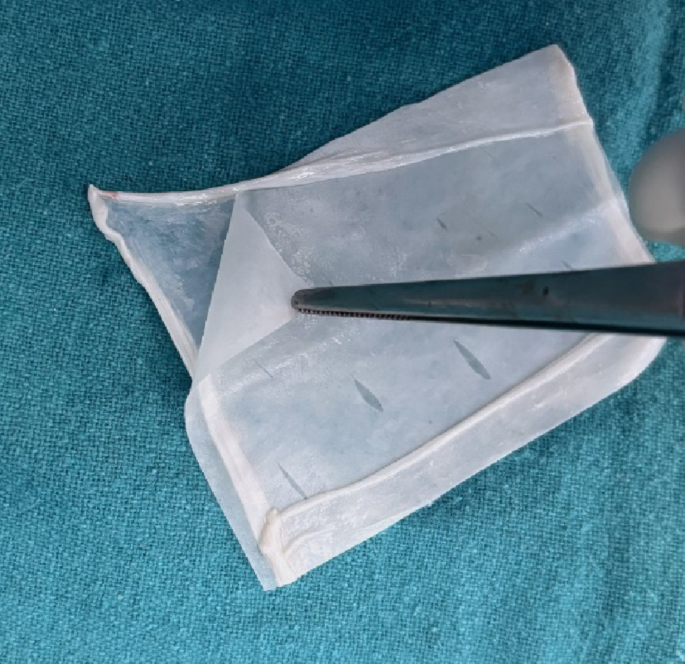 Collagen-Peel with Stay-Suture Anchor: A Simple Technique for Collagen ...