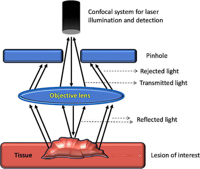 Optical biopsy in gastroenterology: Focus on confocal laser endomicroscopy  | SpringerLink