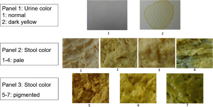 Development Of Integrated Neonatal Cholestasis Card For Early Recognition And Referral Of Neonatal Cholestasis Springerlink