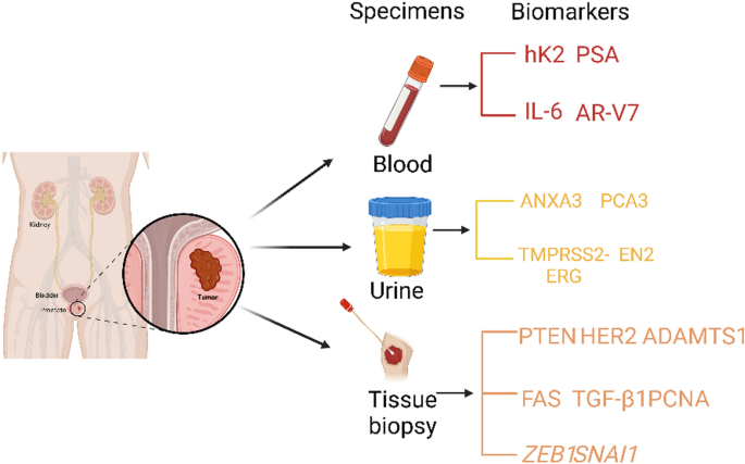 glp 1 and prostate cancer Targeting obesity, metabolic syndrome, and prostate cancer: GLP-1 agonists  as emerging therapeutic agents | Discover Oncology