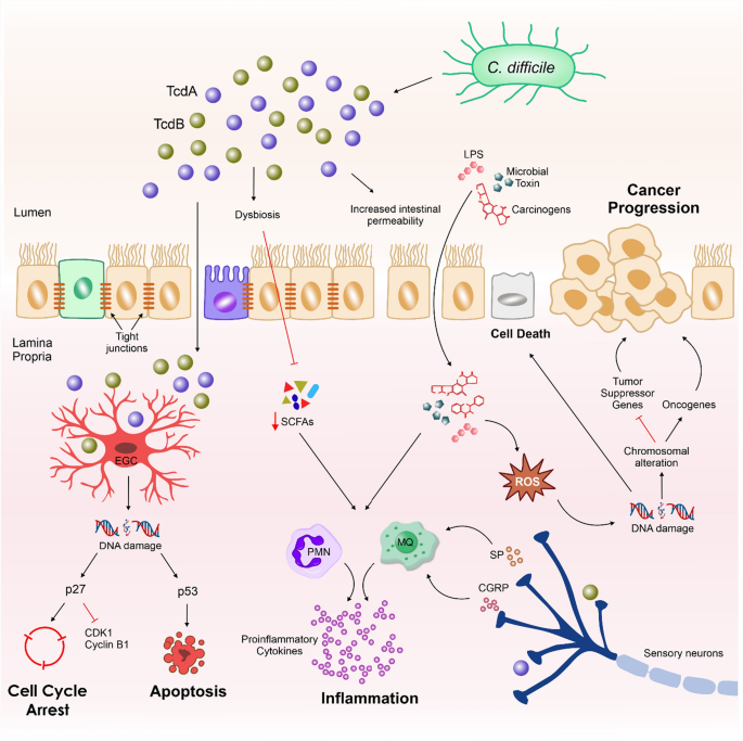 Clostridium difficile as a potent trigger of colorectal carcinogenesis ...