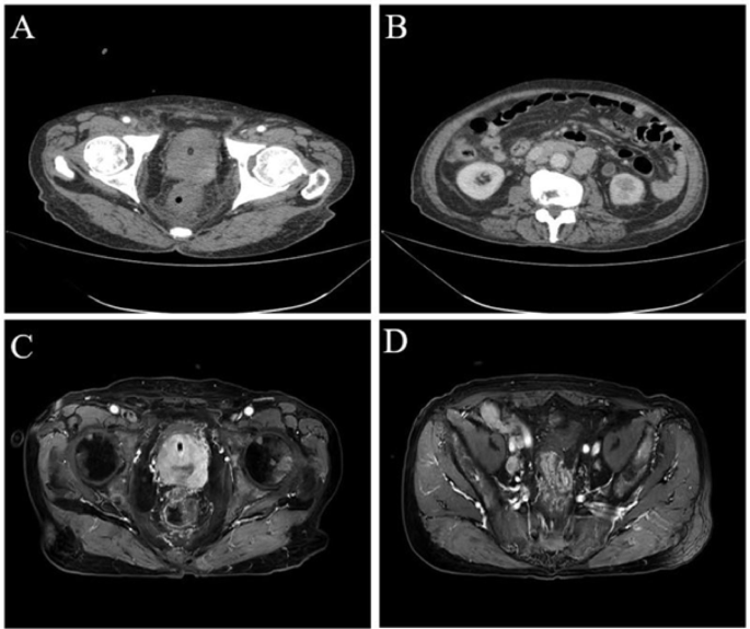 Oesophageal metastasis of prostate cancer: a case report | Discover ...
