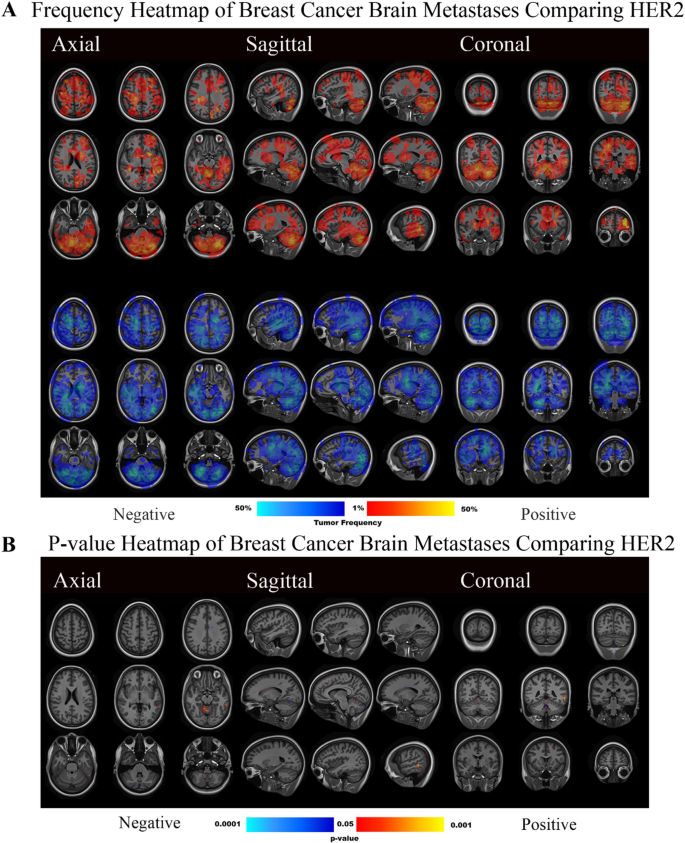 Voxel-wise analysis of brain metastasis predilection sites in breast ...