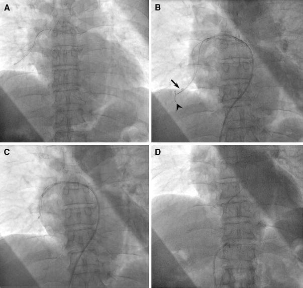 Percutaneous Interventional Techniques To Remove Embolized Silicone Port Catheters From Heart And Great Vessels Springerlink Percutaneous Interventional Techniques To Remove Embolized Silicone Port Catheters From Heart And Great Vessels Springerlink