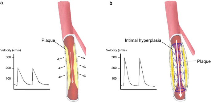 Peak Systolic Velocity Ratio Derived From Quantitative Vessel Analysis For Restenosis After Femoropopliteal Intervention A Multidisciplinary Review From Endovascular Asia Springerlink
