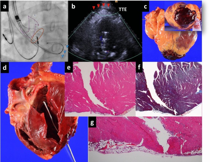 Intramyocardial and epicardial hemorrhage due to left-ventricular wire  during transcatheter aortic valve implantation: an autopsy case |  SpringerLink