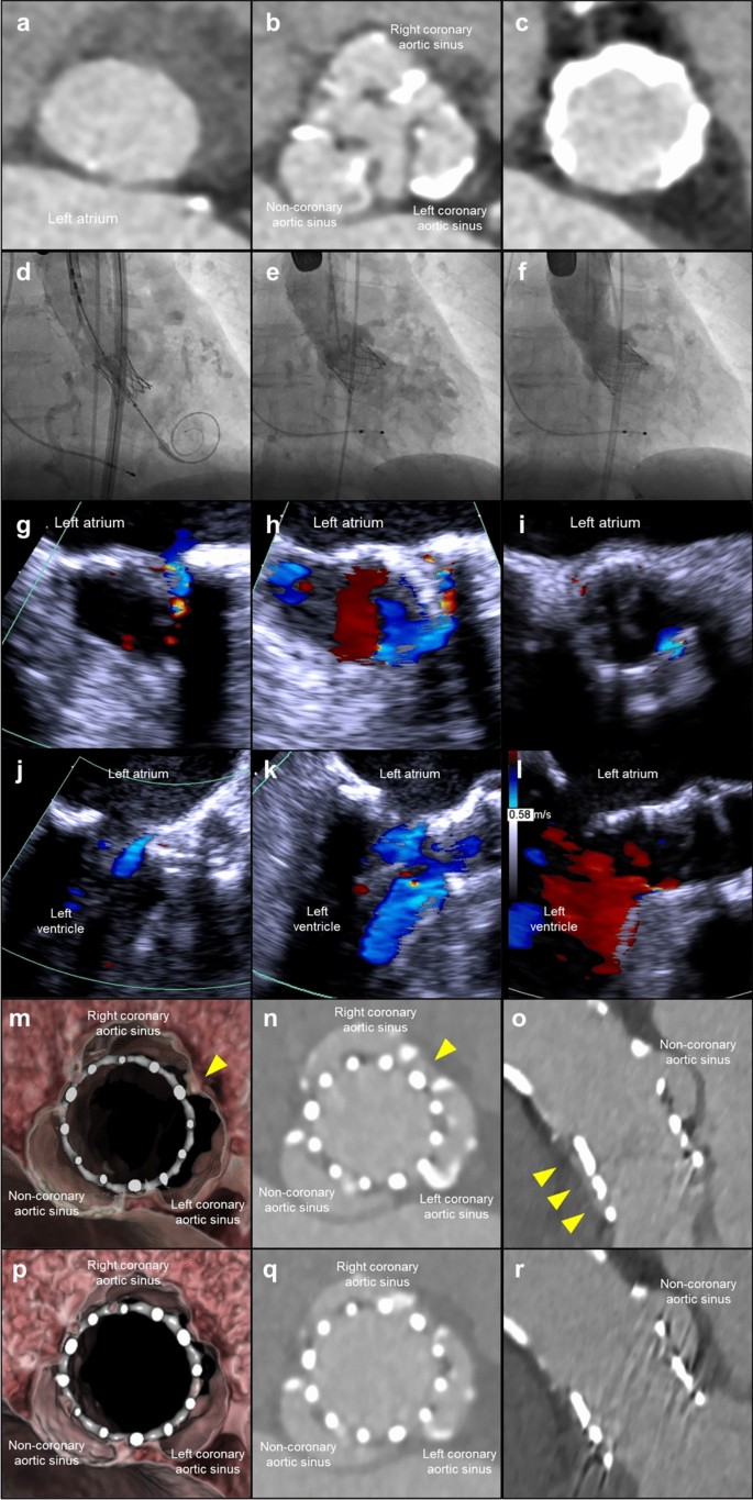 Successful Percutaneous Balloon Aortic Valvuloplasty For Worsening Paravalvular Leakage Detected One Week After The Balloon Expandable Transcatheter Aortic Valve Replacement Springerlink