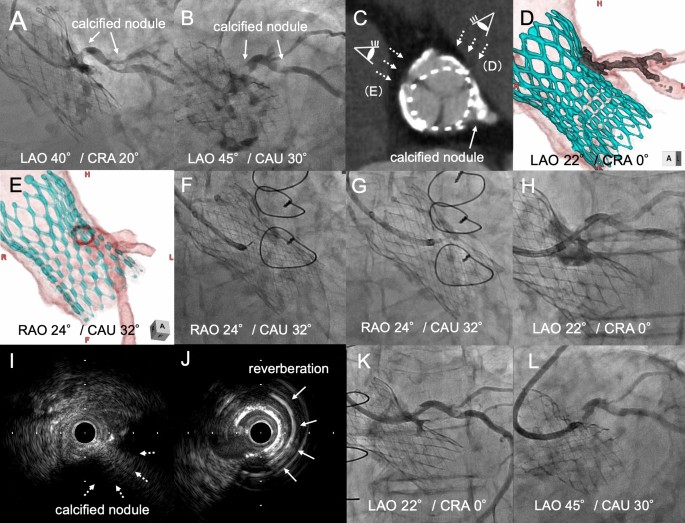 Percutaneous coronary intervention with orbital atherectomy after