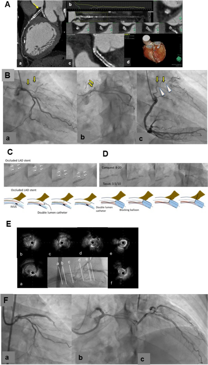 Balloon blocking technique for antegrade wiring in a chronic total  occlusion of the left anterior descending artery ostium | Cardiovascular  Intervention and Therapeutics