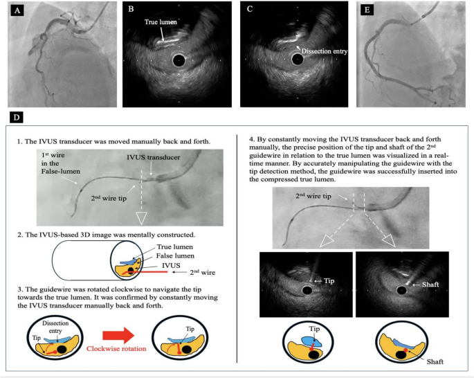 Successful PCI for iatrogenic coronary dissection using IVUS-Guided 3 ...